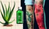 Burn Treatment Essentials: Effective Care Steps You Need